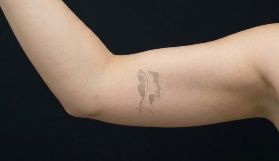 Arms liposculpture — after