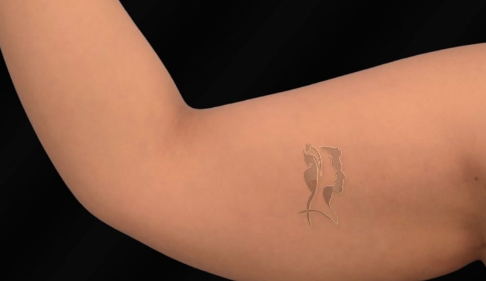 Arms liposculpture — before