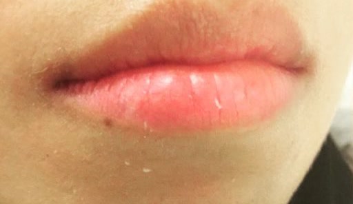 Lip filler — before