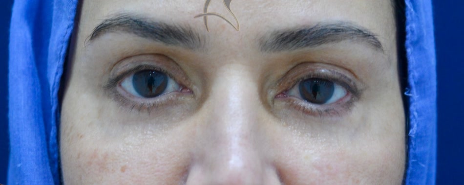 Lower blepharoplasty — after