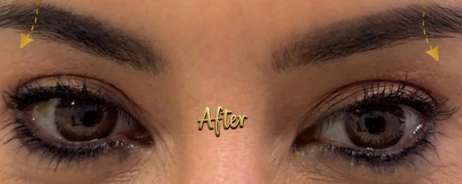 Upper blepharoplasty — after